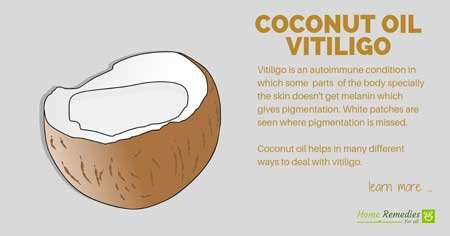 coconut oil for vitiligo