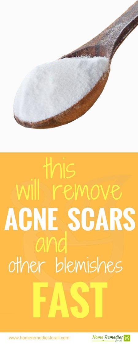 baking soda for acne scars infographic