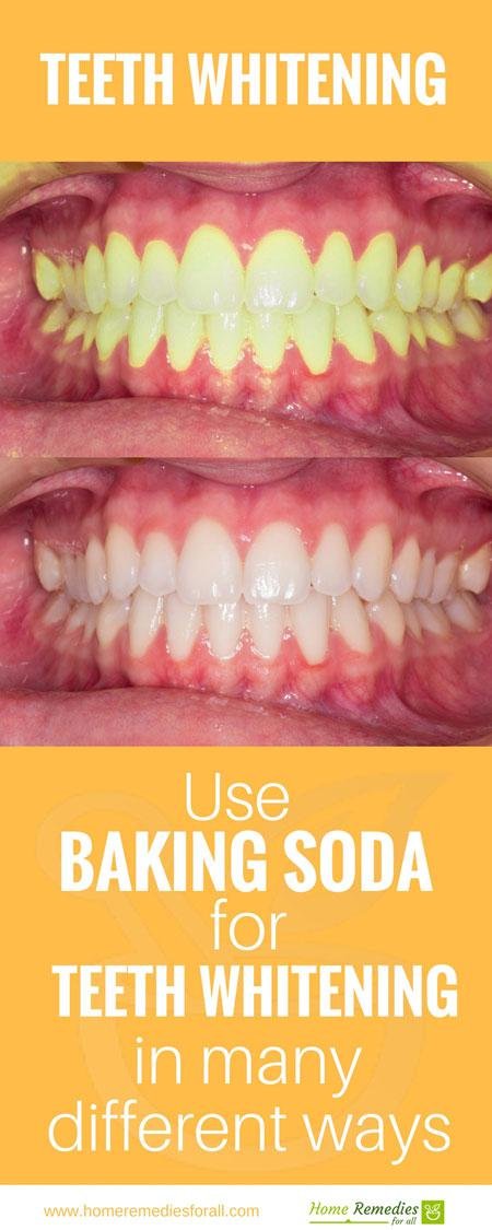 baking soda for teeth whitening infographic