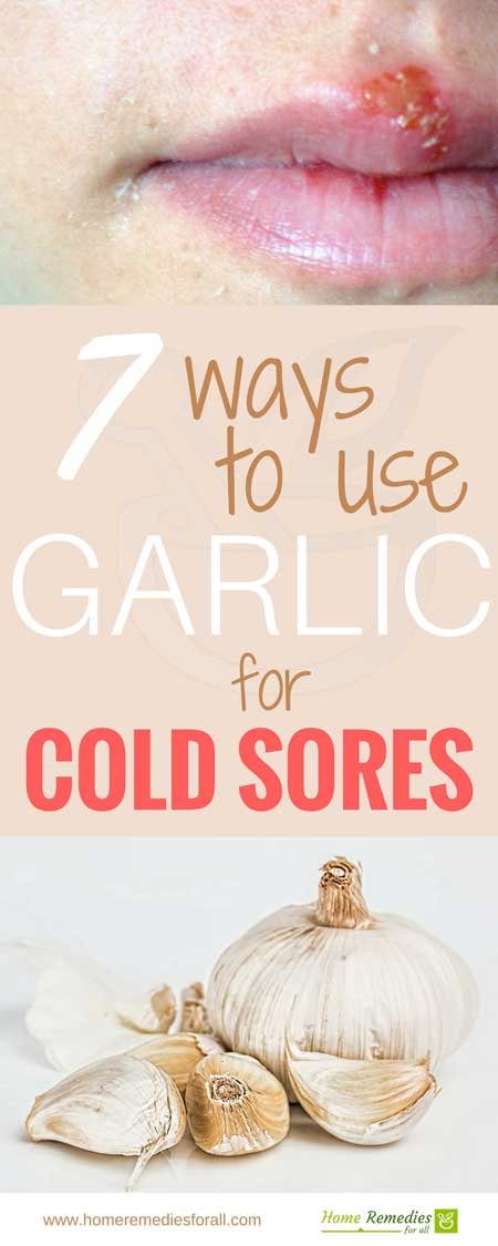 garlic for cold sores infographic