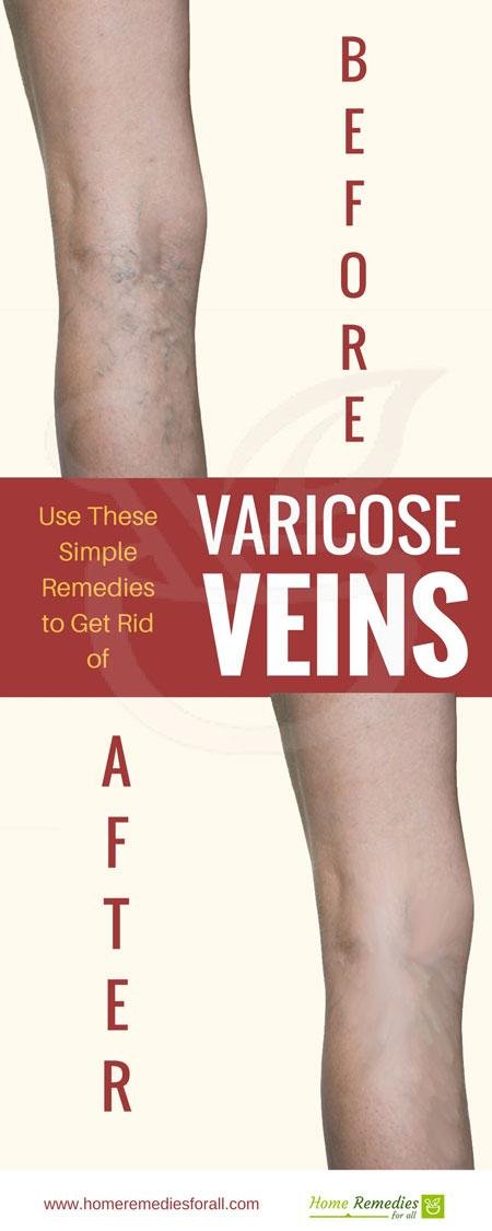 varicose veins remedies infographic