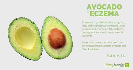 avocado for eczema