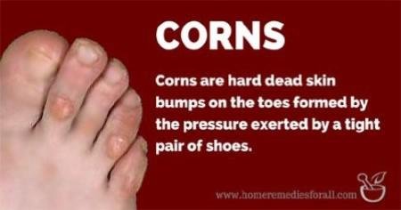 Get Rid of Corns