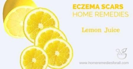 Lemon Juice for Eczema