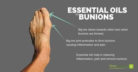 essential oils for bunions