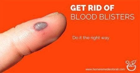 Blood blister on finger