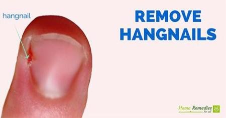 Picture of a hangnail