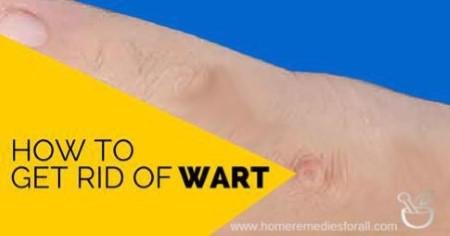 How to Get Rid of Warts