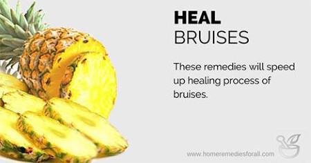 How to Heal a Bruise Fast