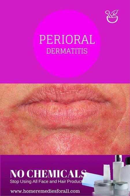 Picture of Perioral Dermatitis Cures