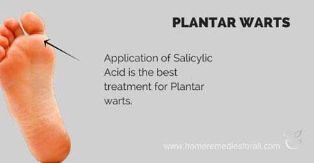 Salicylic acid for warts